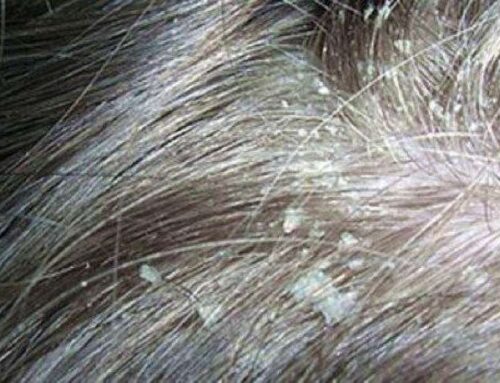 Seborrea canina (“caspa en el gos”)